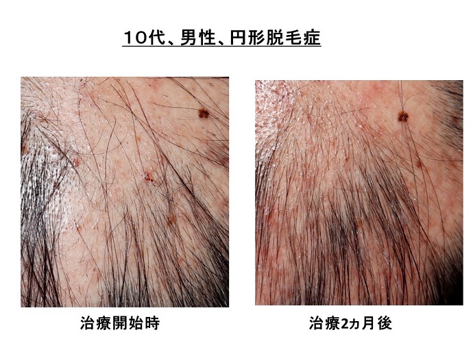 円形脱毛症　病院